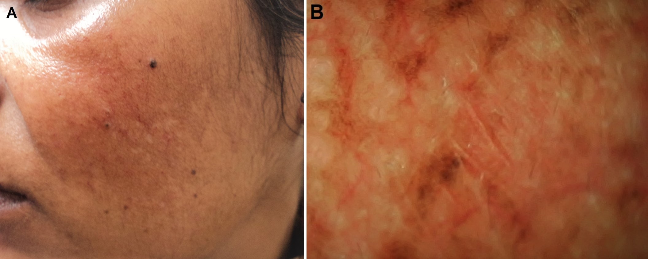 Melasma Article