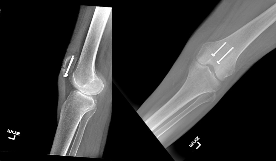 Patella Fractures Article