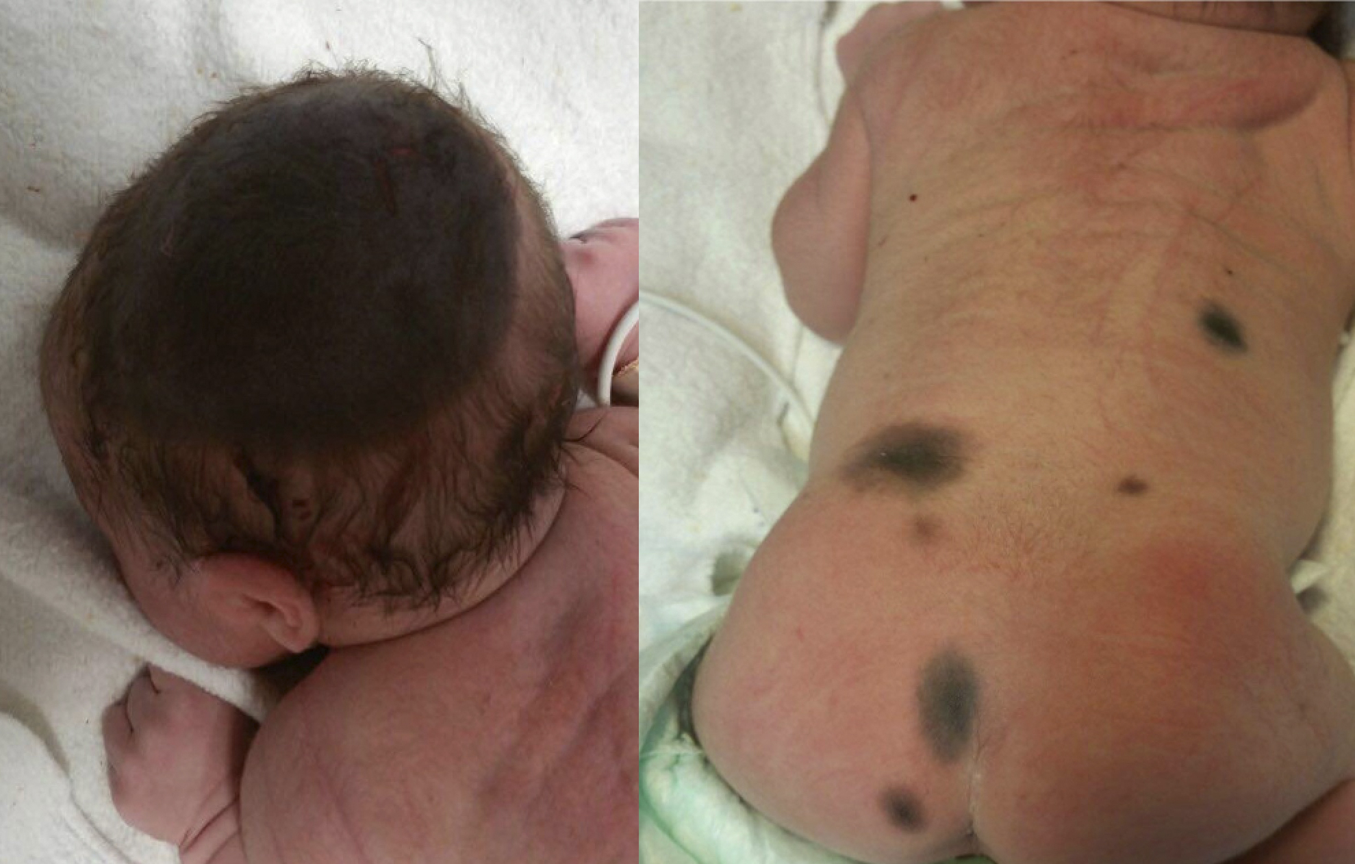 Congenital Nevus Article