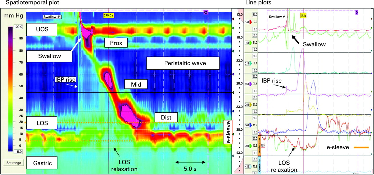 Esophageal Manometry Article