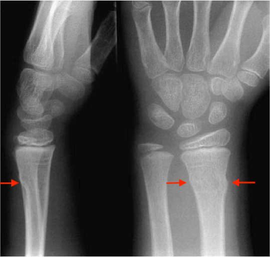 Pediatric Torus Buckle Fracture Treatment Management Point Of Care