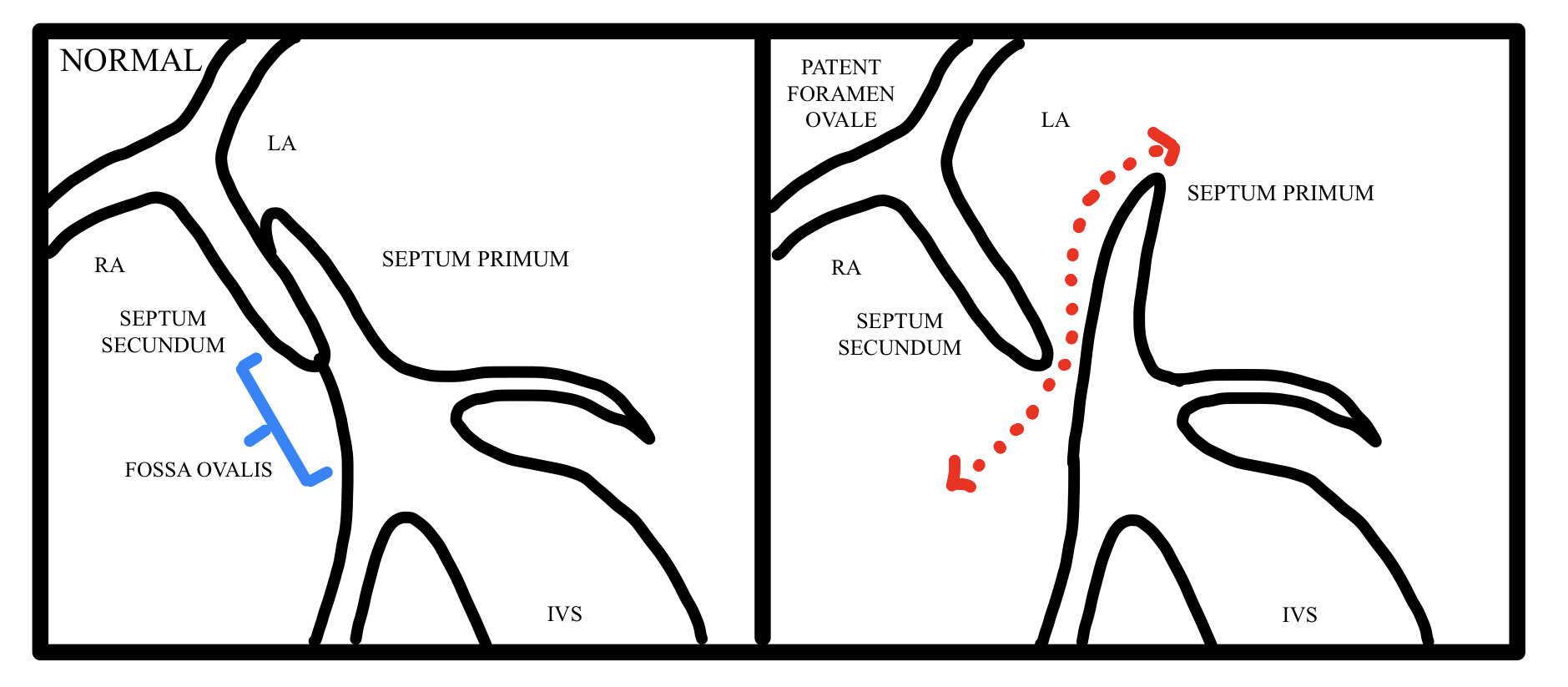 The Anatomy Structure And Physiology Function Of The Fossa Ovalis