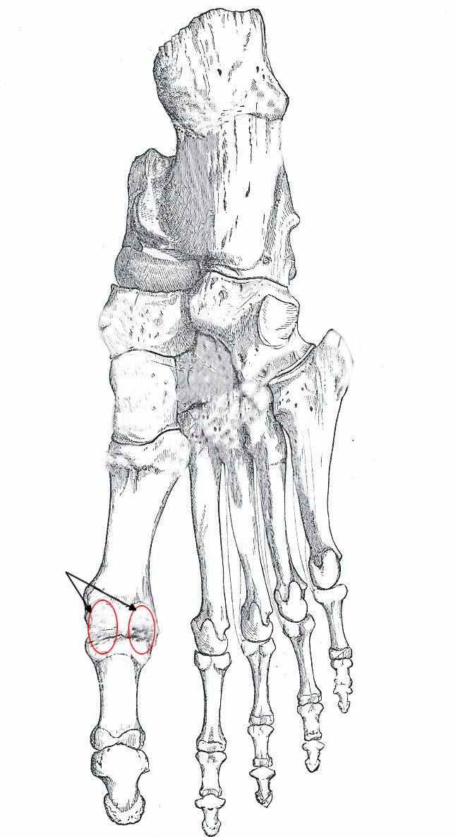 Anatomy Sesamoid Bones Treatment Management Point Of Care