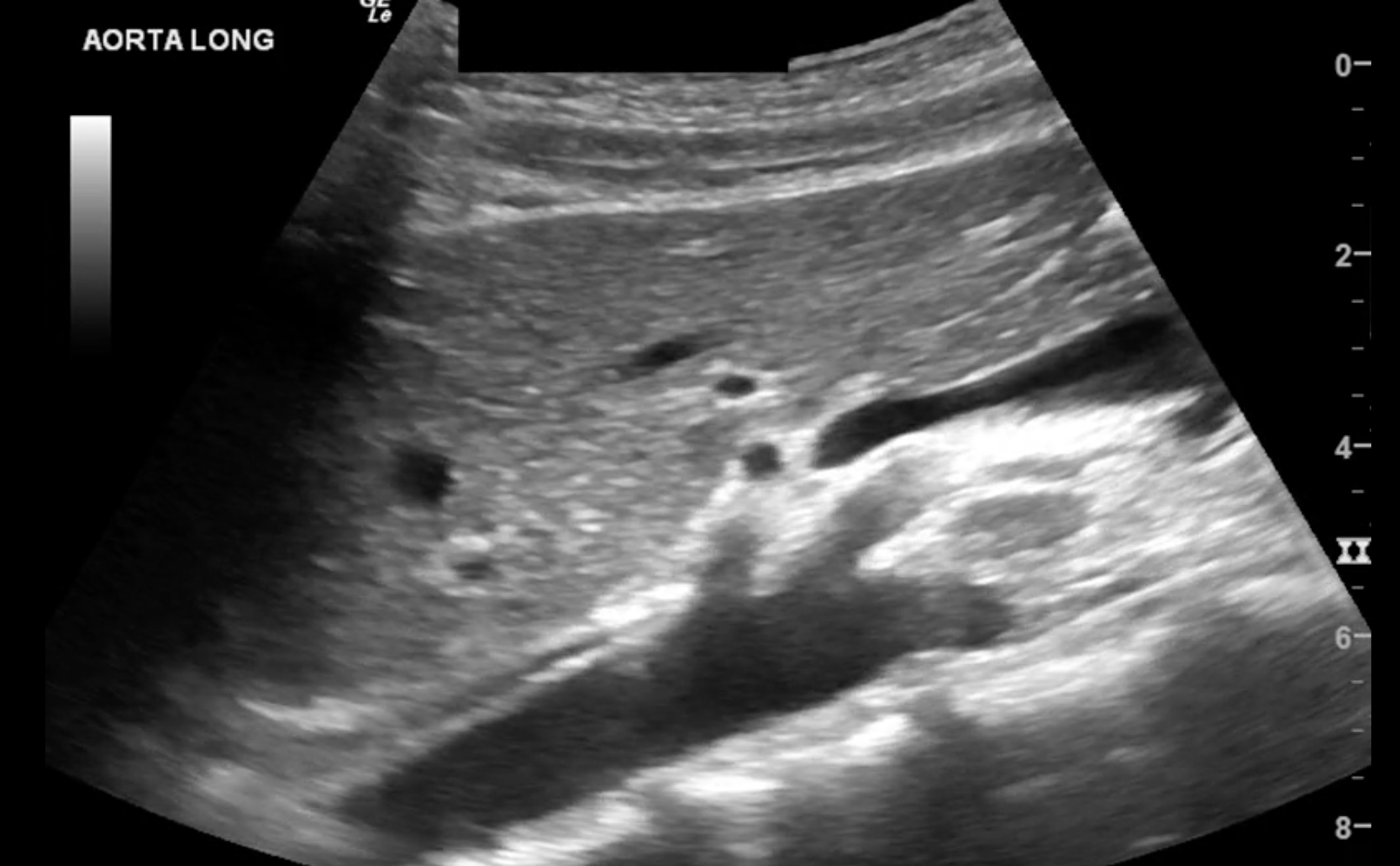 Sonography Abdominal Vascular Assessment Protocols And Interpretation