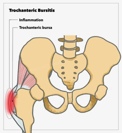 Greater Trochanteric Bursa Injection Treatment Management Point