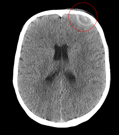 Pott Puffy Tumor Treatment Management Point Of Care