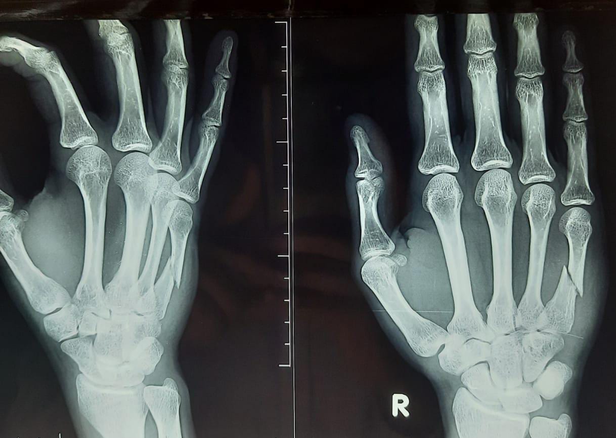 Metacarpal Fracture Treatment Management Point Of Care