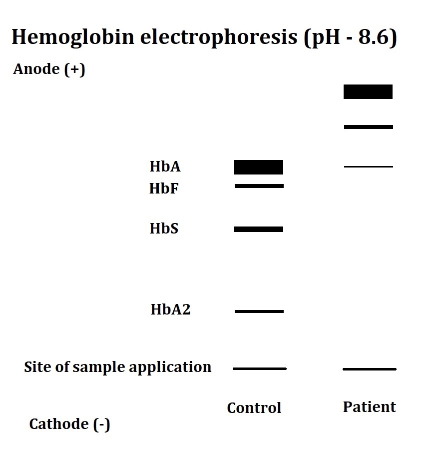 Laboratory Evaluation Of Alpha Thalassemia Article