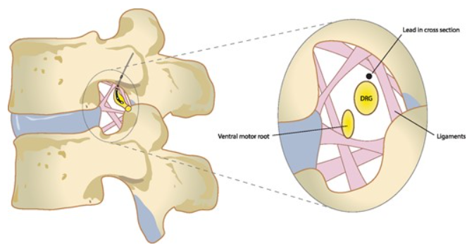 Neuroanatomy Dorsal Root Ganglion Article