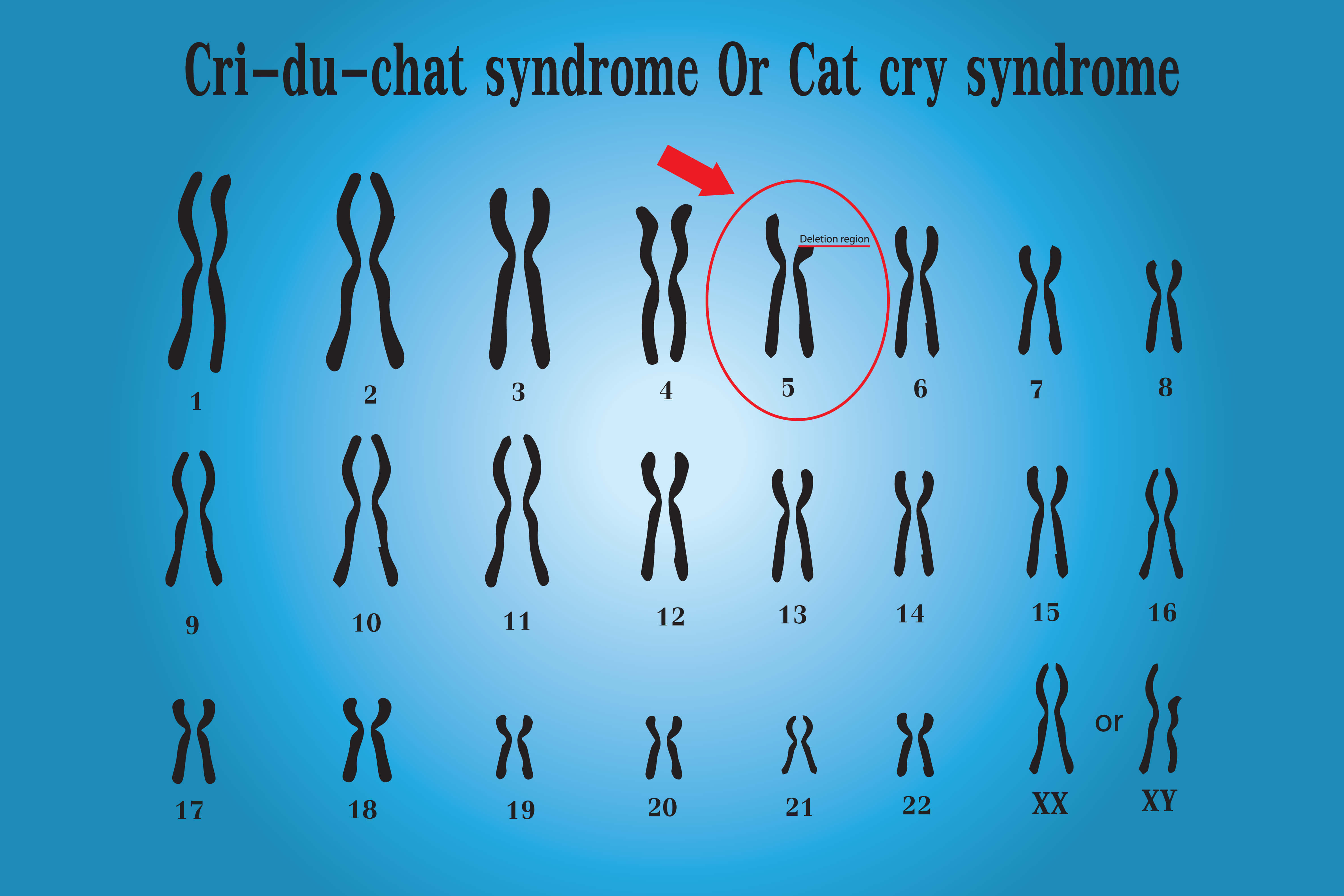 CE Activity Cri Du Chat Syndrome Nurses