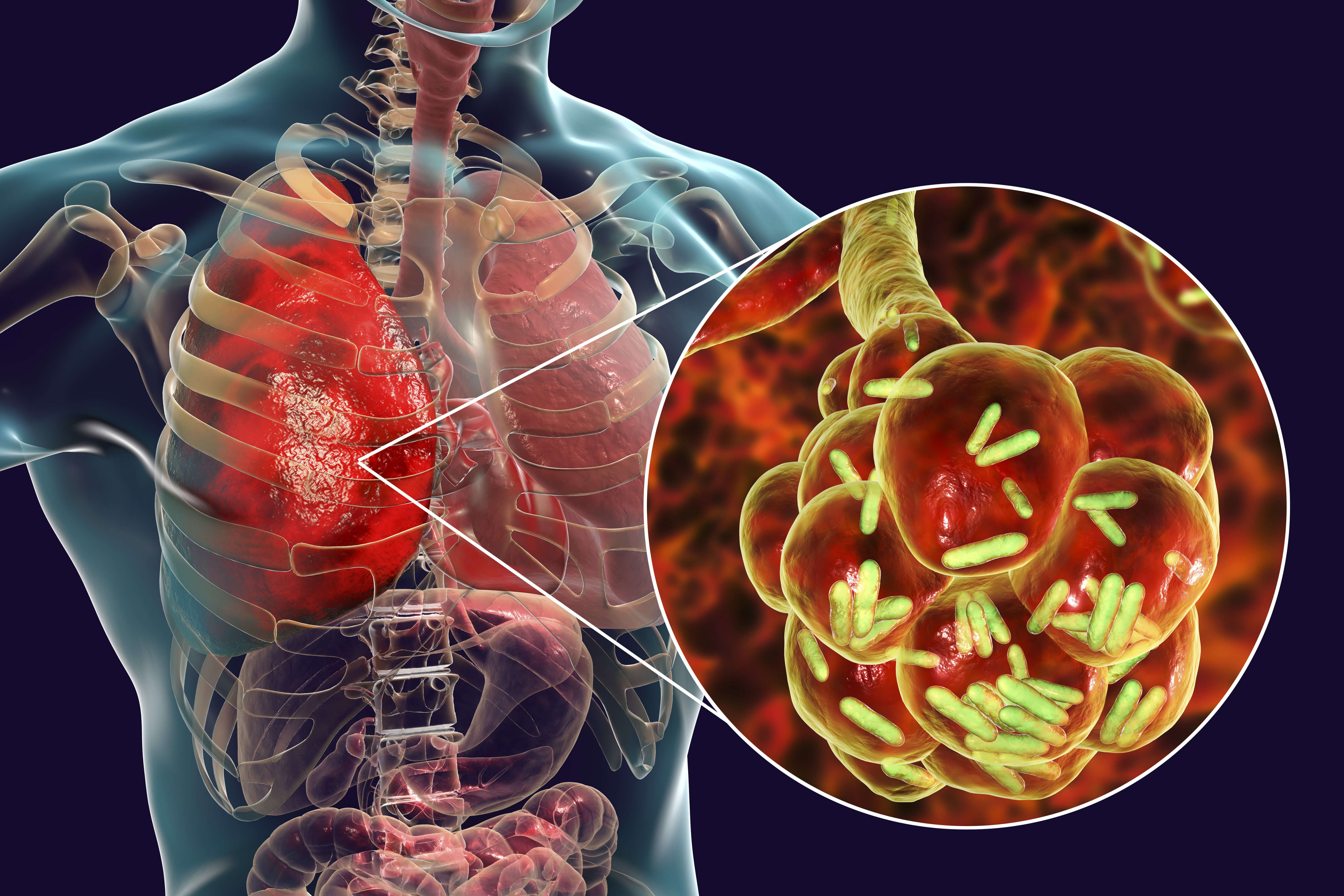 CE Activity Bacterial Pneumonia Nurses