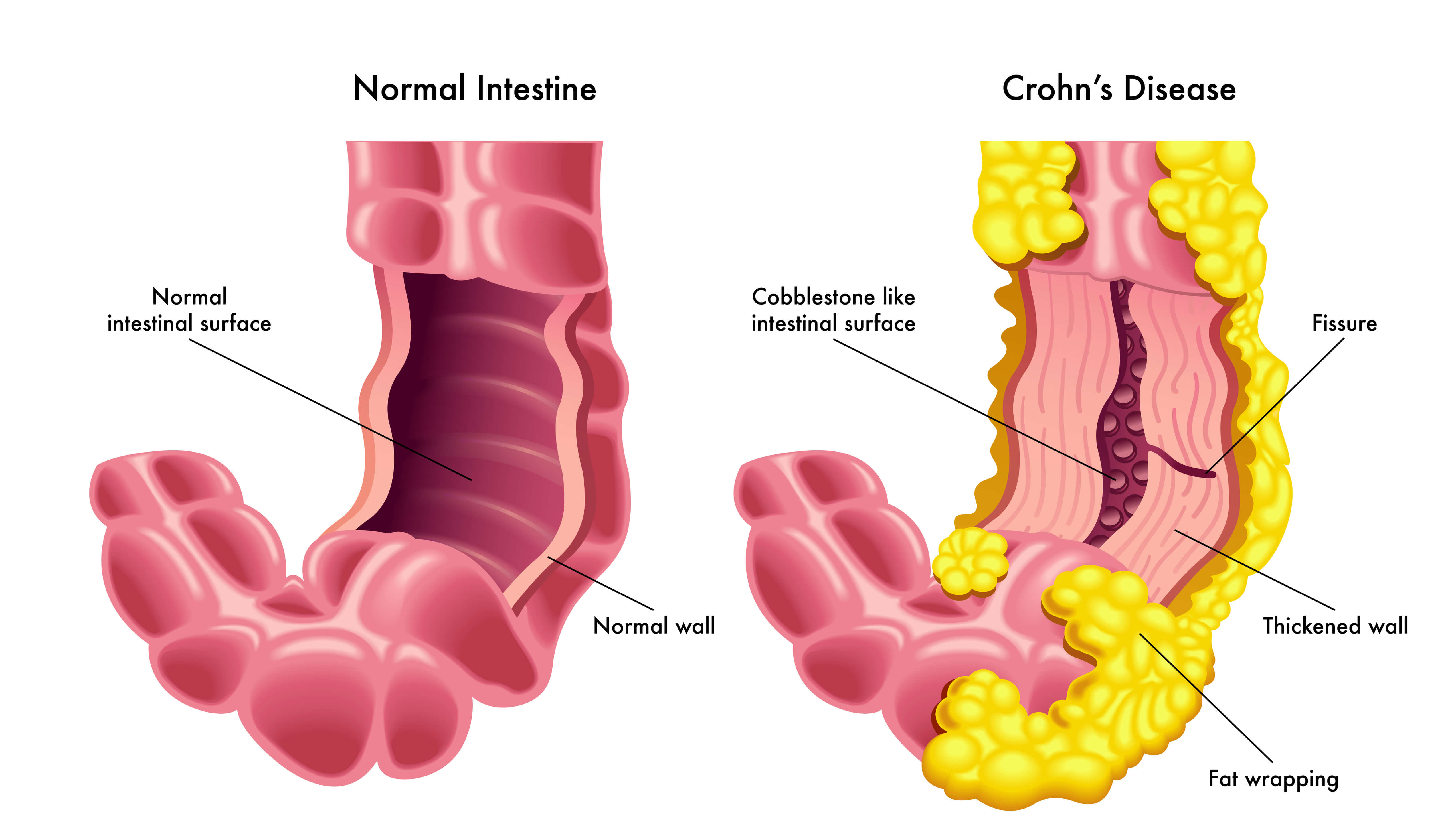 CE Activity Cutaneous Crohn Disease Nurses