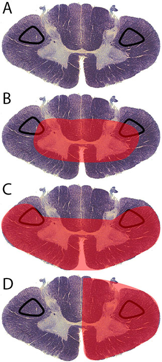 <p>Corticospinal Tract Lesion Locations