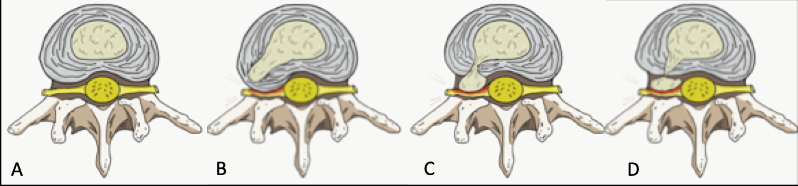 Figure 1. A) Normal disc anatomy B) Disc Protrusion C) Disc Extrusion D) Disc Sequestration
