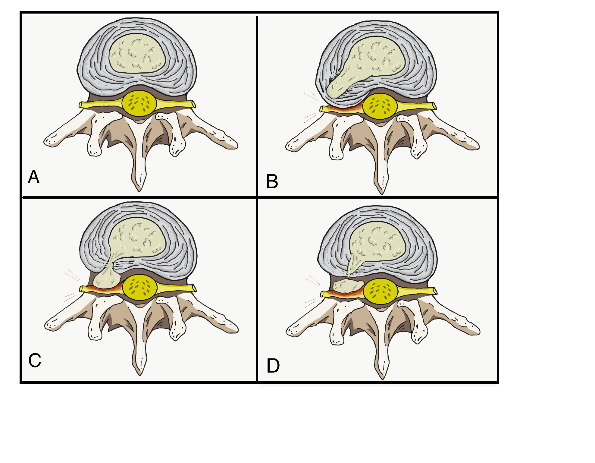 <p>Stages of Nucleus Pulposus Herniation. A. Normal B. Bulging C. Protrusion D. Herniation</p>