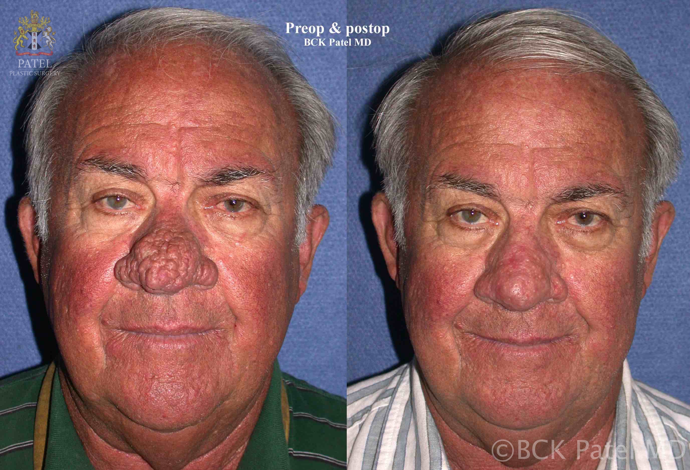 58-year-old gentleman undersent scalpel resection of the rhinophyma and immediate CO2 laser resurfacing and shrinkage of the surrounding tissues with healing by secondary intention