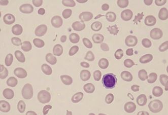 Peripheral blood picture of beta thalassemia major patient showing hypochromic, microcytic red blood cells along with target cells