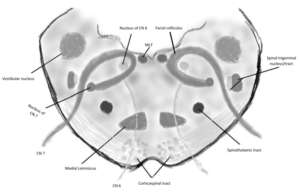 <p>Foville Syndrome Anatomy. Shown at the level of the inferomedial pons.</p>