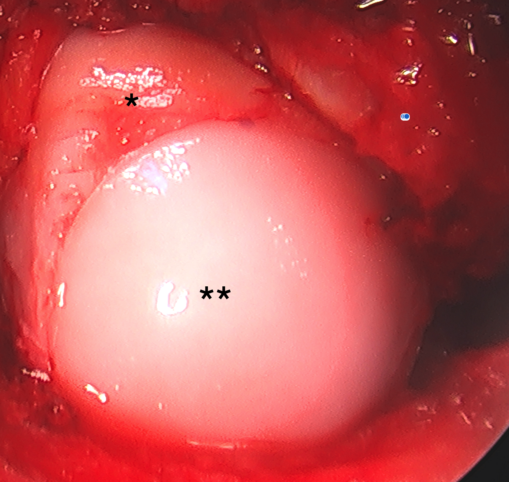 Intraoperative imaging capturing osteochondral allograft implantation (**) after measuring technical diameter and depth following guide facilitated intraoperative measurements