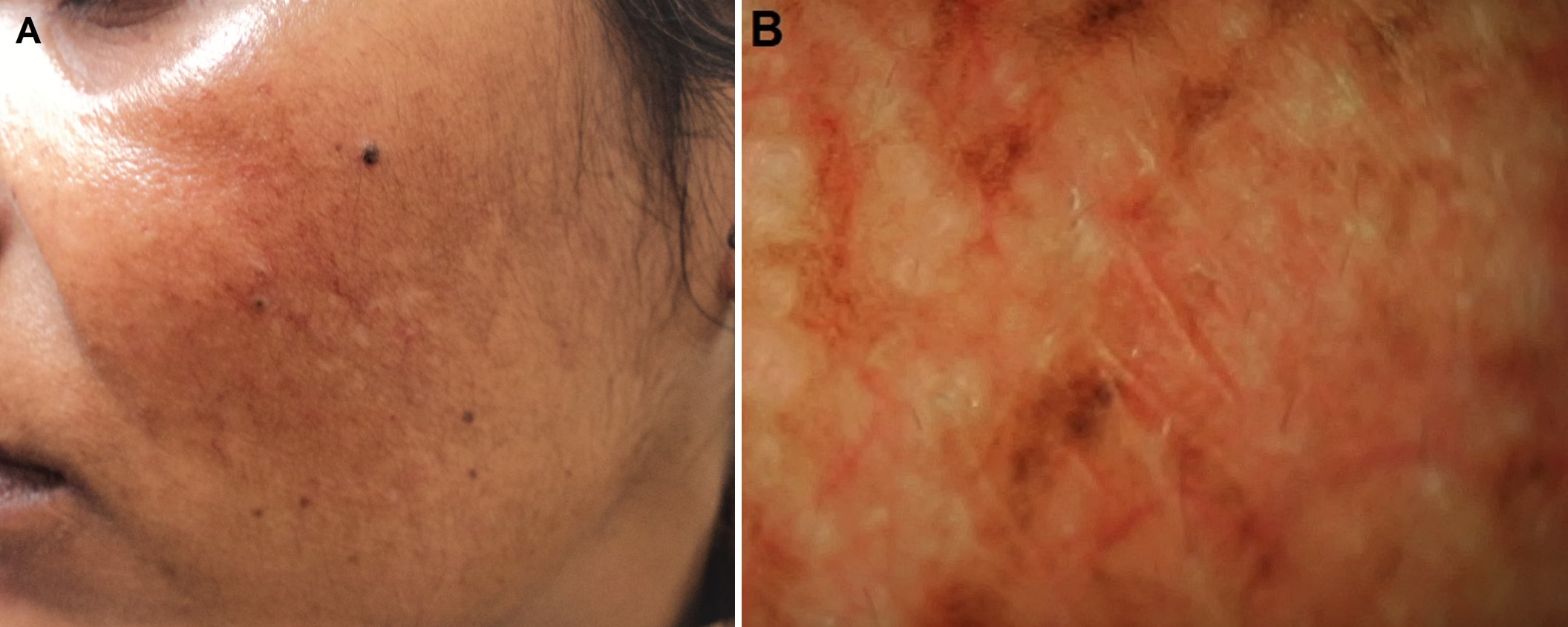 Figure 1: Treatment refractory melasma with history of mild photosensitivity in a 35-year old woman: A, Clinical image; and B, Dermoscopic image [E-Scope, Timpac Health Care Pvt