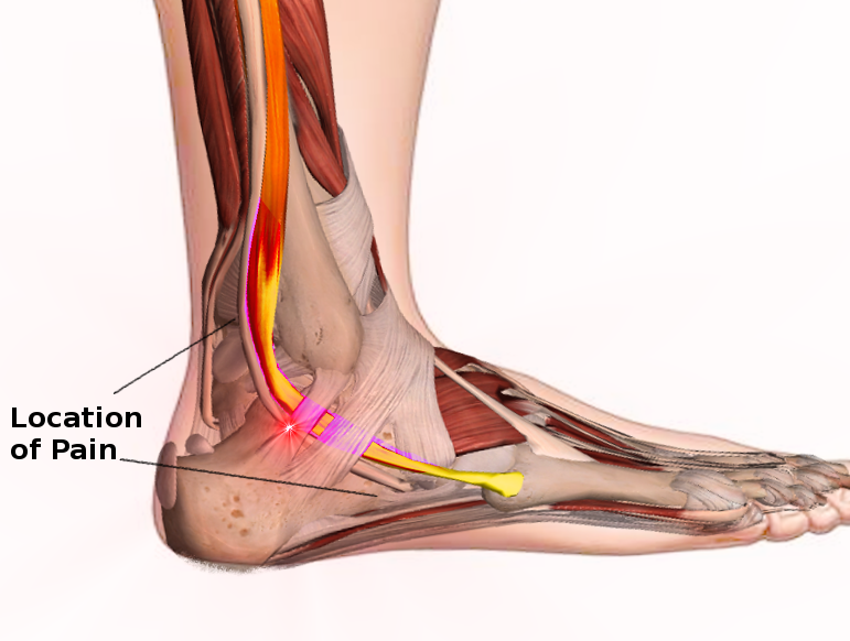 Peroneal Tendon Syndromes Article