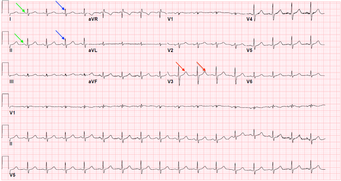 Figure 1: Normal EKG showing P waves (green arrows), QRS complex (blue arrows), and T waves (red arrows)