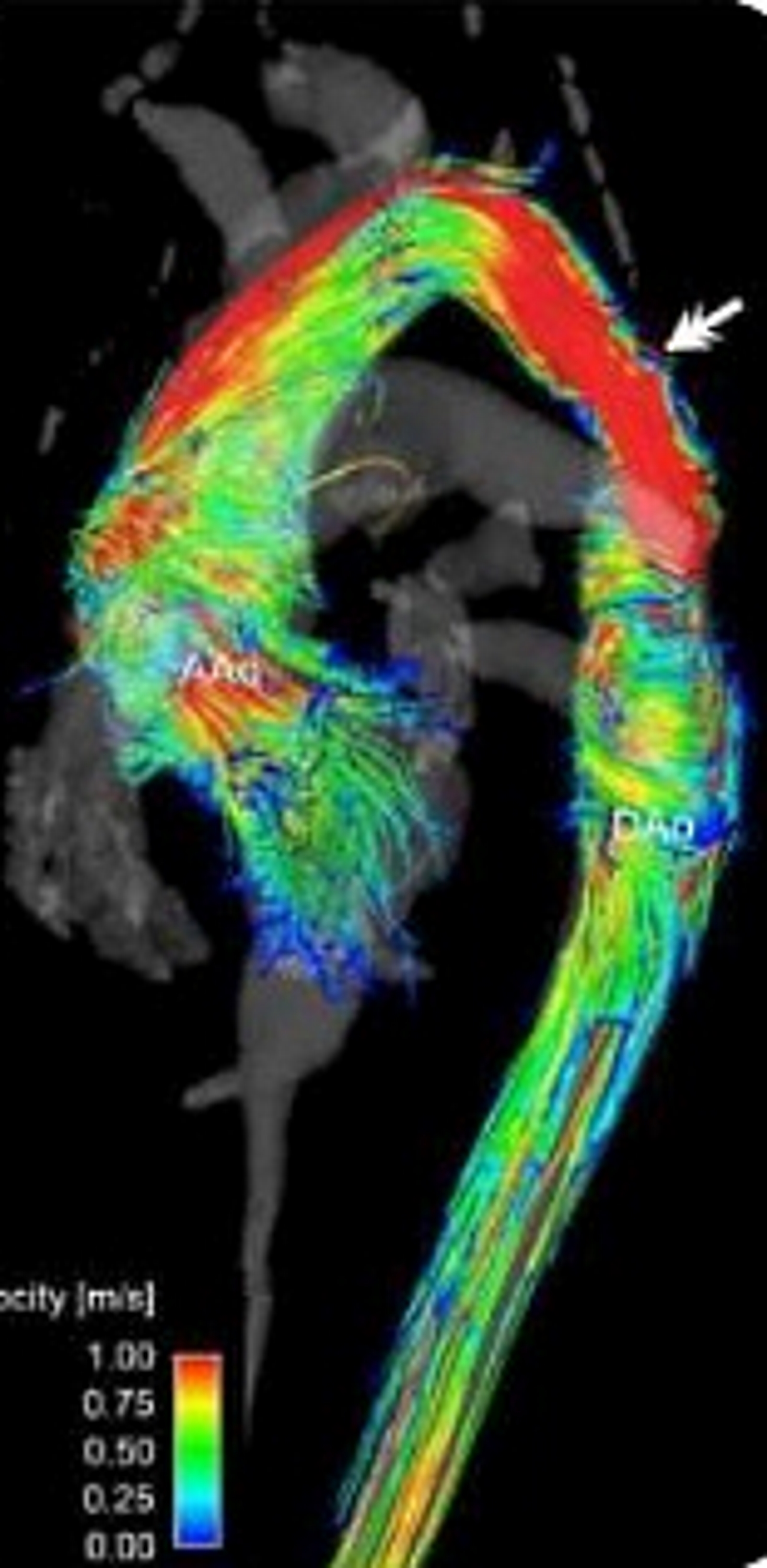 Computerized angio-tomographic showing coarctation of the aorta