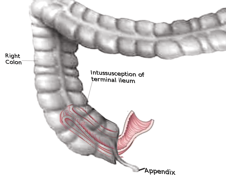 Intussusception of small bowel