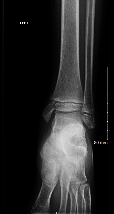 Salter-Harris III fracture through the distal tibia