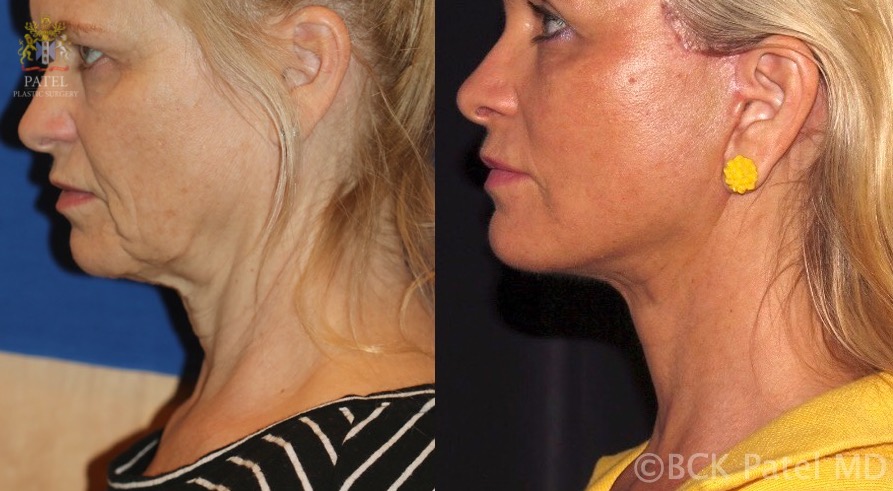 <p>Result of a Deep-Plane Facelift