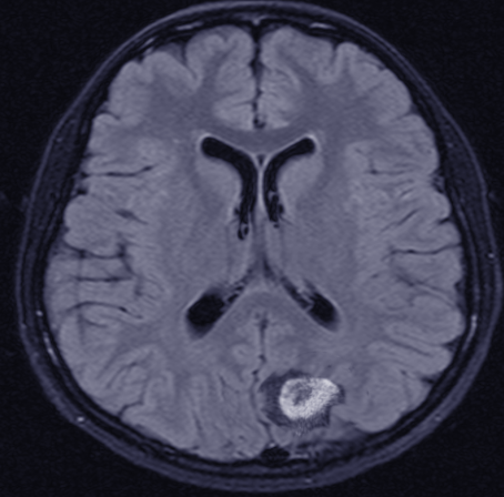<p>Central Nervous System Lymphoma, Magnetic Resonance Image