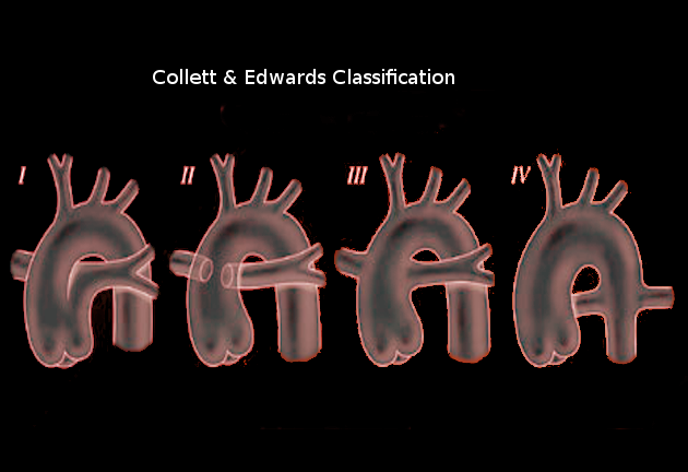 <p>Collett&nbsp;and Edwards' Truncus Arteriosus Classification