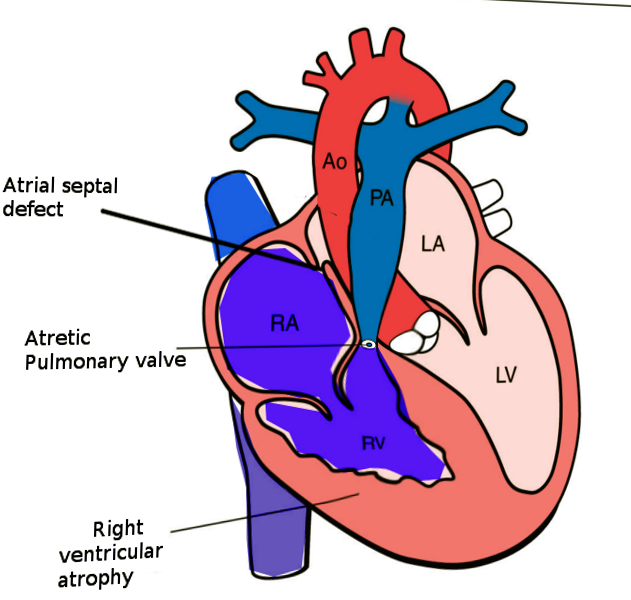 <p>Pulmonary Atresia With Intact Ventricular&nbsp;Septum</p>