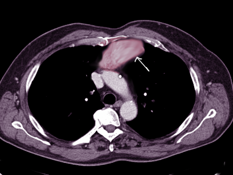 <p>Anterior Mediastinal Mass on Chest Computed Tomography