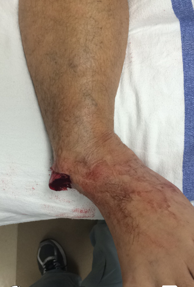 Open Fracture Management
Open fracture of the ankle with exposed fibular present. Gustilo Type 2