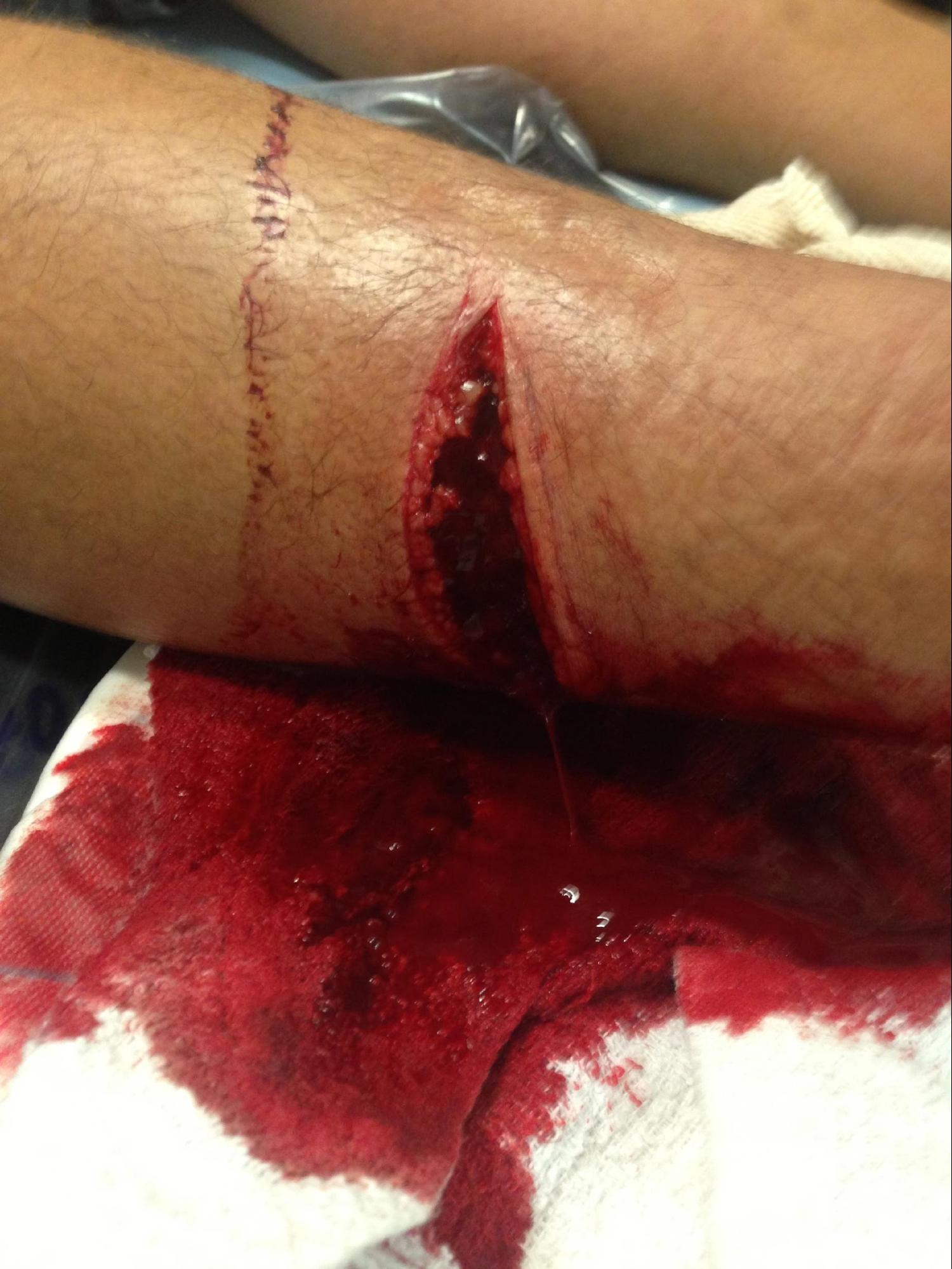 <p>Laceration of the Right Lower Leg. Full-thickness laceration of the right lower leg.</p>