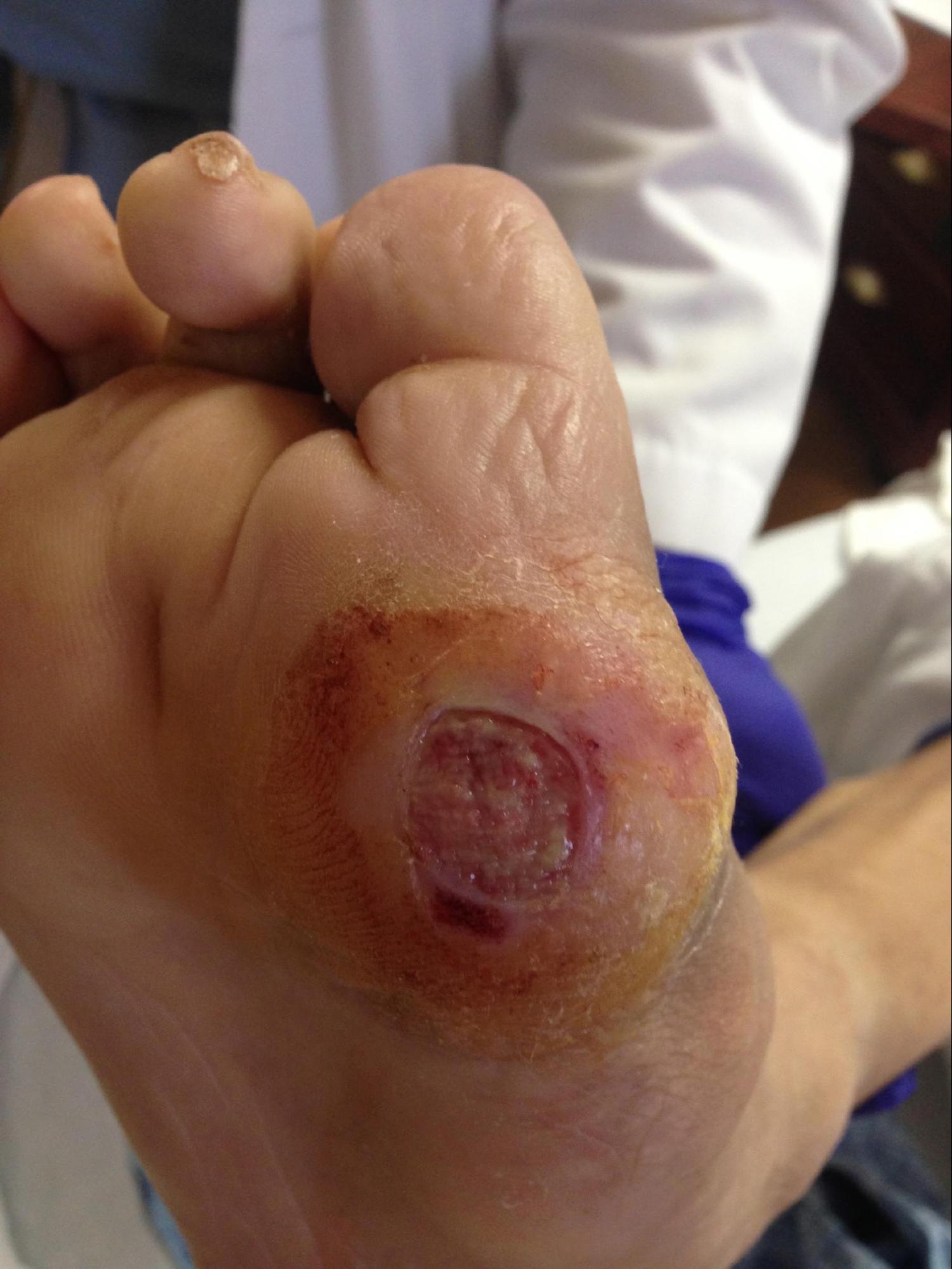 Diabetic Ulcer
Due to neuropathy, vasculopathy, and foot deformity. 
Note periwound callous formation. Wagner Grade 2