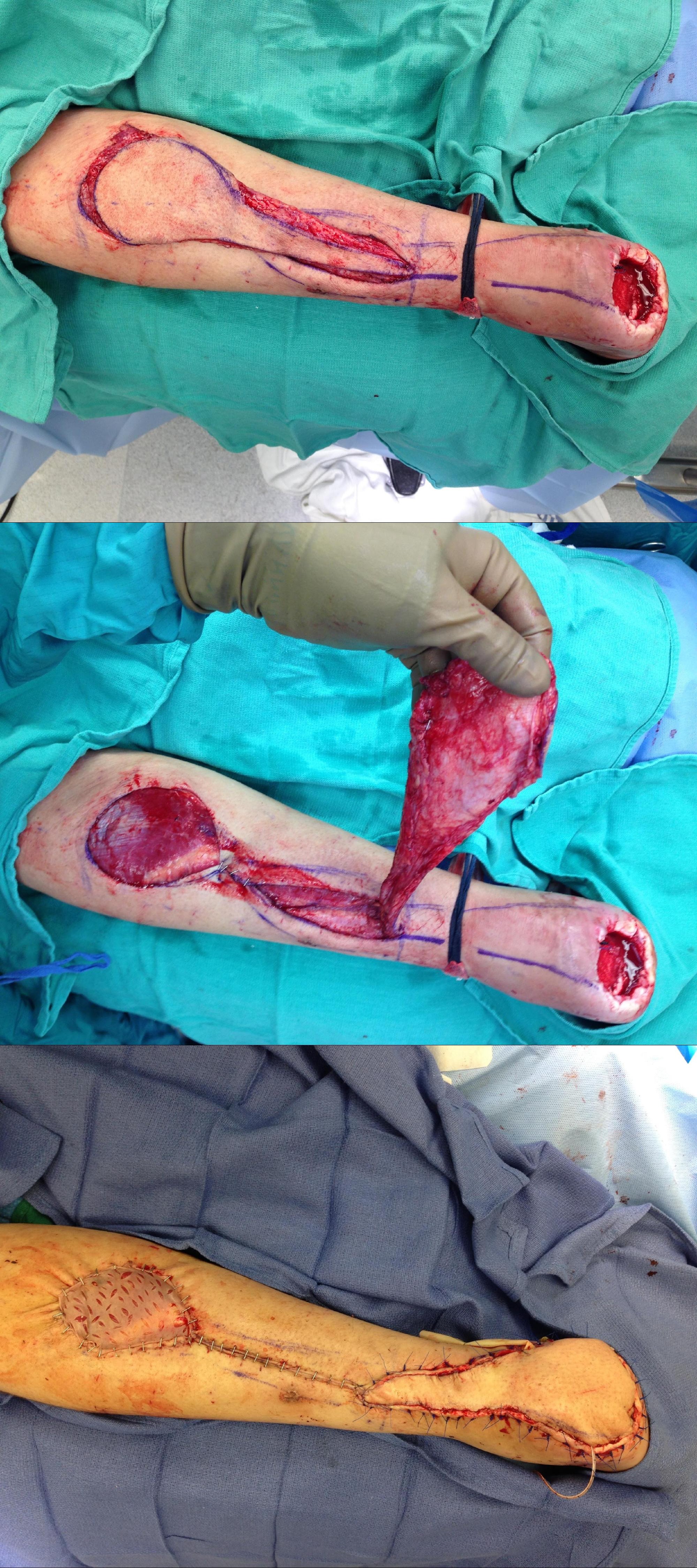 Rotation Flap
Reverse Sural Artery Flap for reconstruction of non-healing heel ulcer.