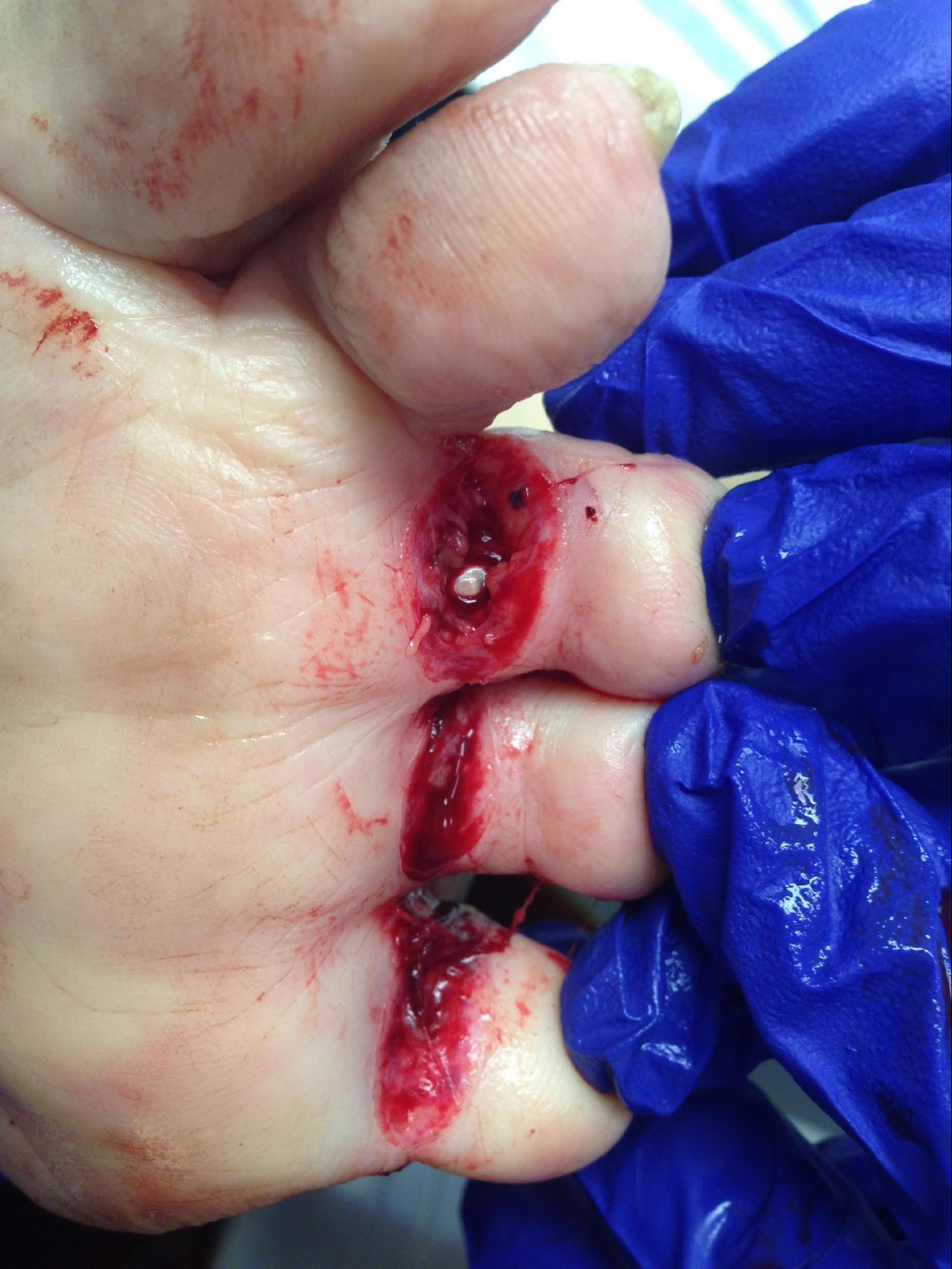 <p>Flexor Tendon Laceration. Laceration of skin and flexor tendons of toes 3-5.</p>