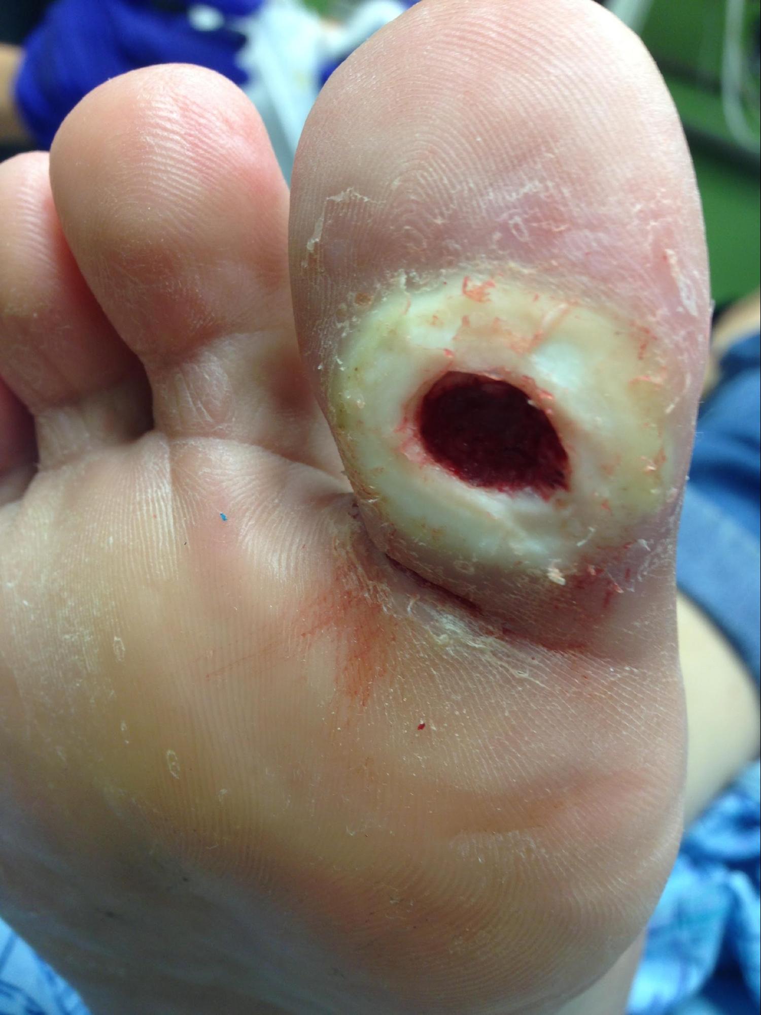 <p>Diabetic Foot Ulcer