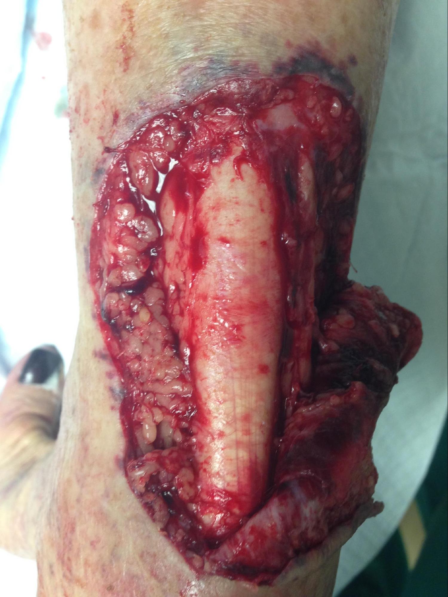 <p>Laceration of the Posterior Ankle. Full-thickness skin laceration of the posterior ankle exposing the Achilles tendon.</p>