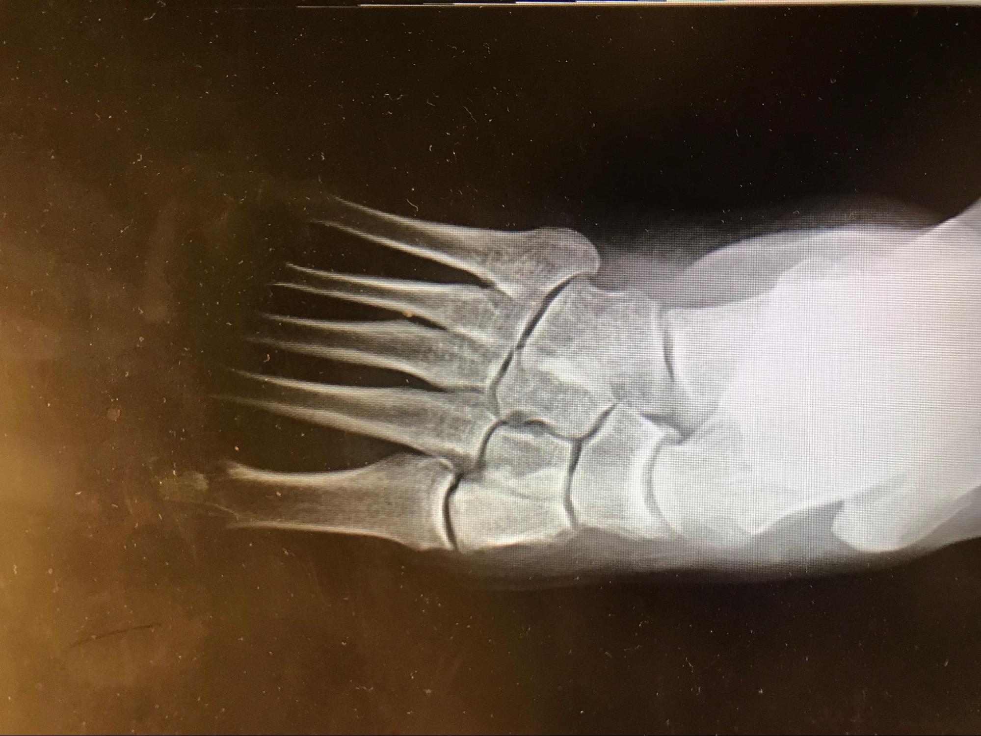 Adult Acquired Flatfoot
Radiograph demonstrating AAFD with increased talar head uncoverage and forefoot abduction.