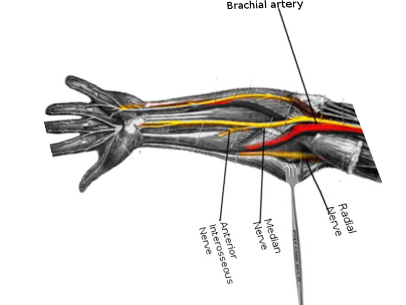 Median nerve arm
