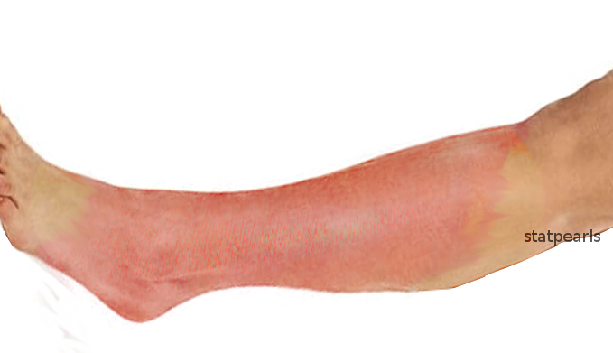Cellulitis of the extremity