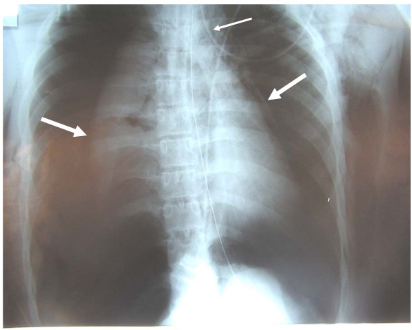 <p>Chest X-ray With Bilateral Pneumothoraces</p>