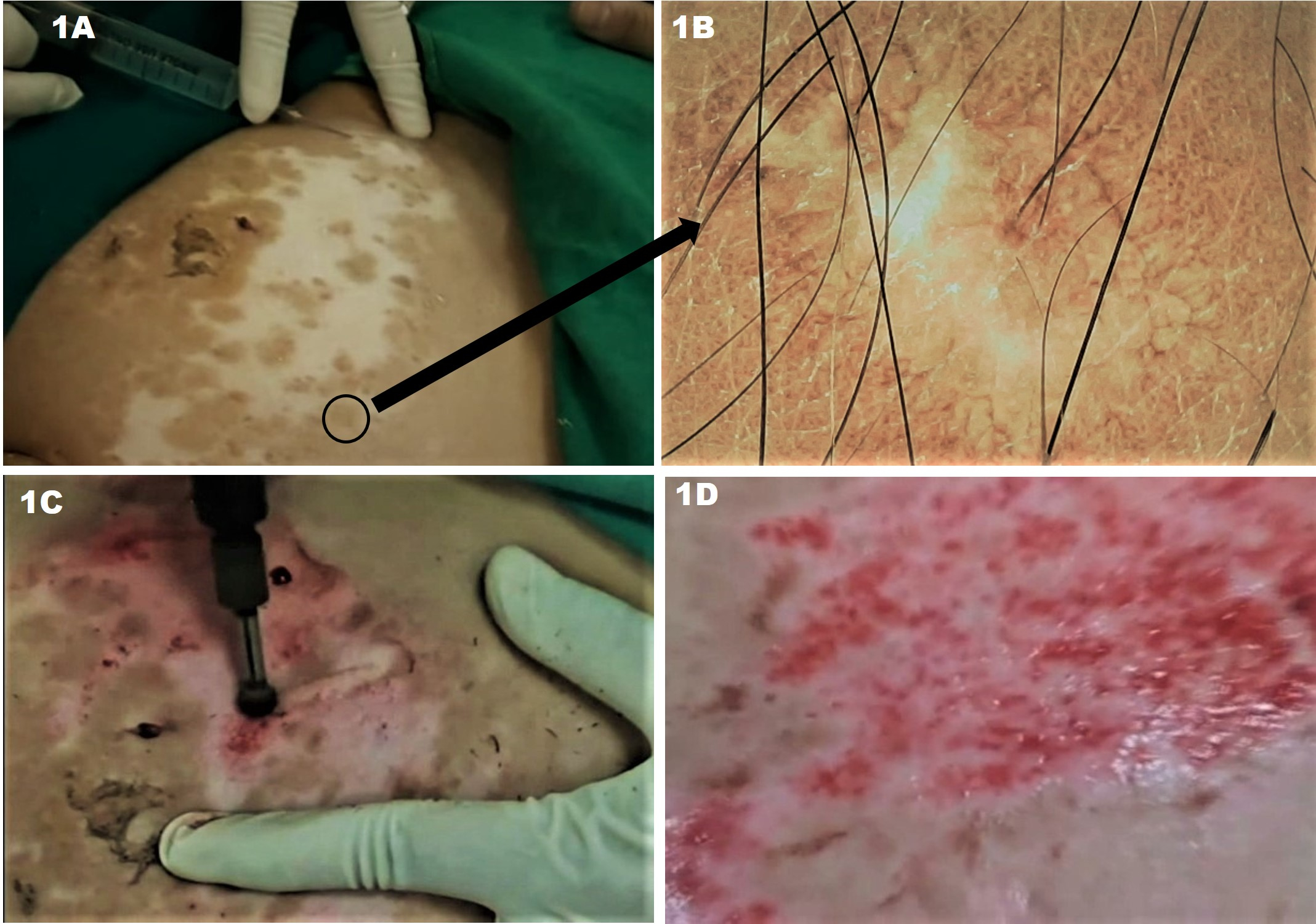 Figure 1 Step-by-step depiction of the Jodhpur technique for repigmenting lesions of stable vitiligo in a young lady: (A) The baseline image of residual but stable vitiligo lesions over the abdomen (refractory to medical and phototherapy)