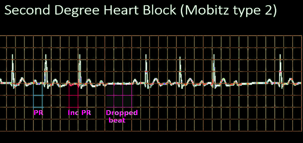 Mobitz 2 heart block