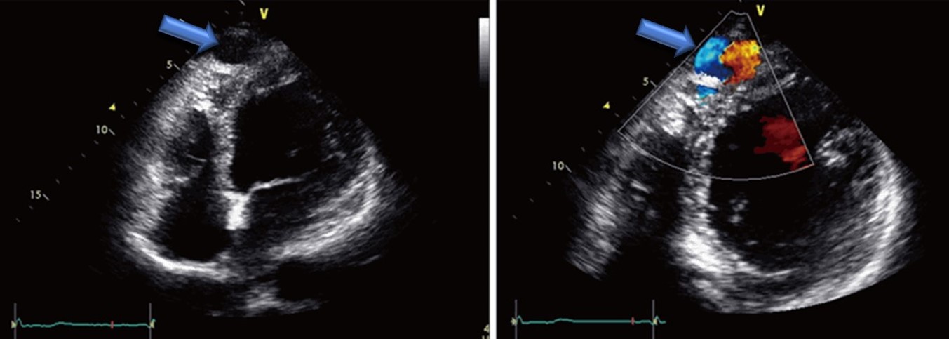 <p>Cardiac Ultrasound of a Coronary Cameral Fistula Draining Into the Left Ventricle in an Adult</p>