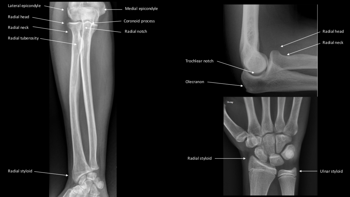 Left image shows an AP radiograph of the forearm