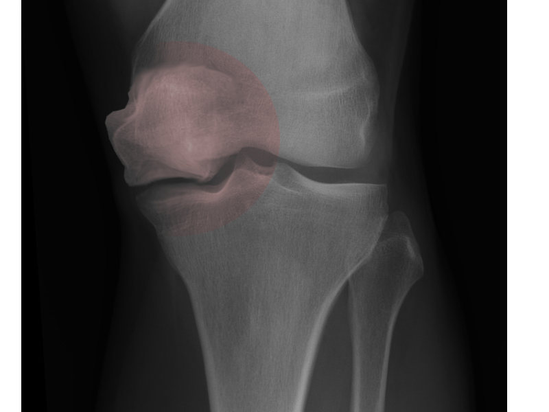 <p>Spontaneous Osteonecrosis of the Knee